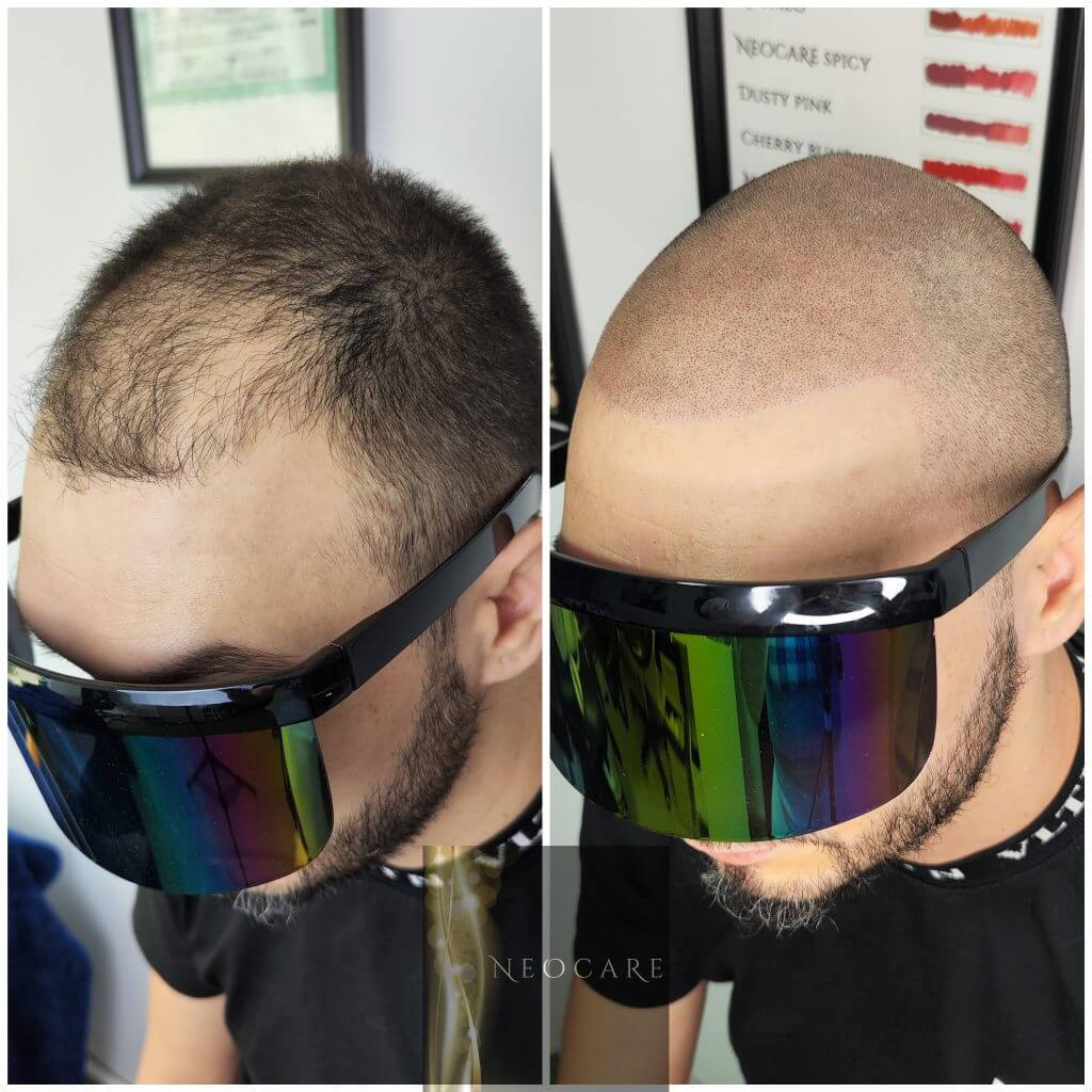 micropigmentare scalp