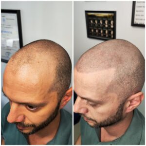 micropigmentare scalp