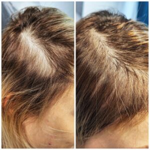 micropigmentare scalp