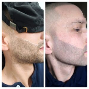 micropigmentare-barba-bucuresti-alopecie-barba
