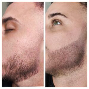 micropigmentare-barba-bucuresti
