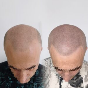 micropigmentare-scalp-barbati-chelie-barbati-romania