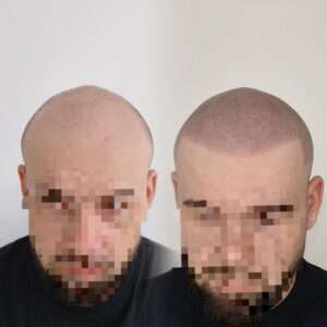 micropigmentare-scalp-bucuresti-efect-par-ras-sedinta-3