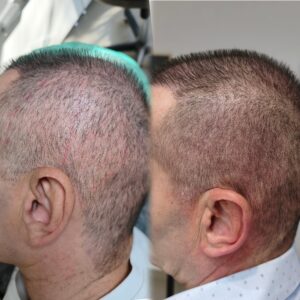 micropigmentare-scalp-cicatrici