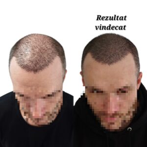 micropigmentare scalp