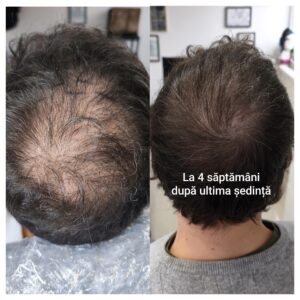 micropigmentare-scalp-barbati-bucuresti-chelie-alopecie